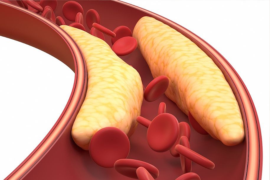 Desvendando a Dislipidemia: 5 Aspectos Essenciais que Todos Devem Conhecer