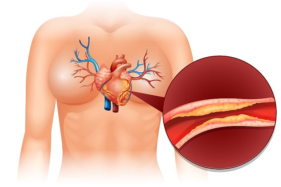 Por que evitar o colesterol é fundamental para a saúde do seu coração?